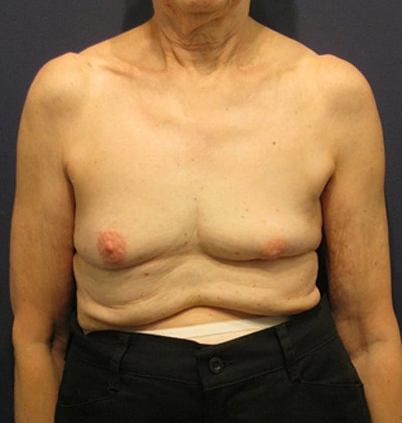 Breast Reconstruction Before & After