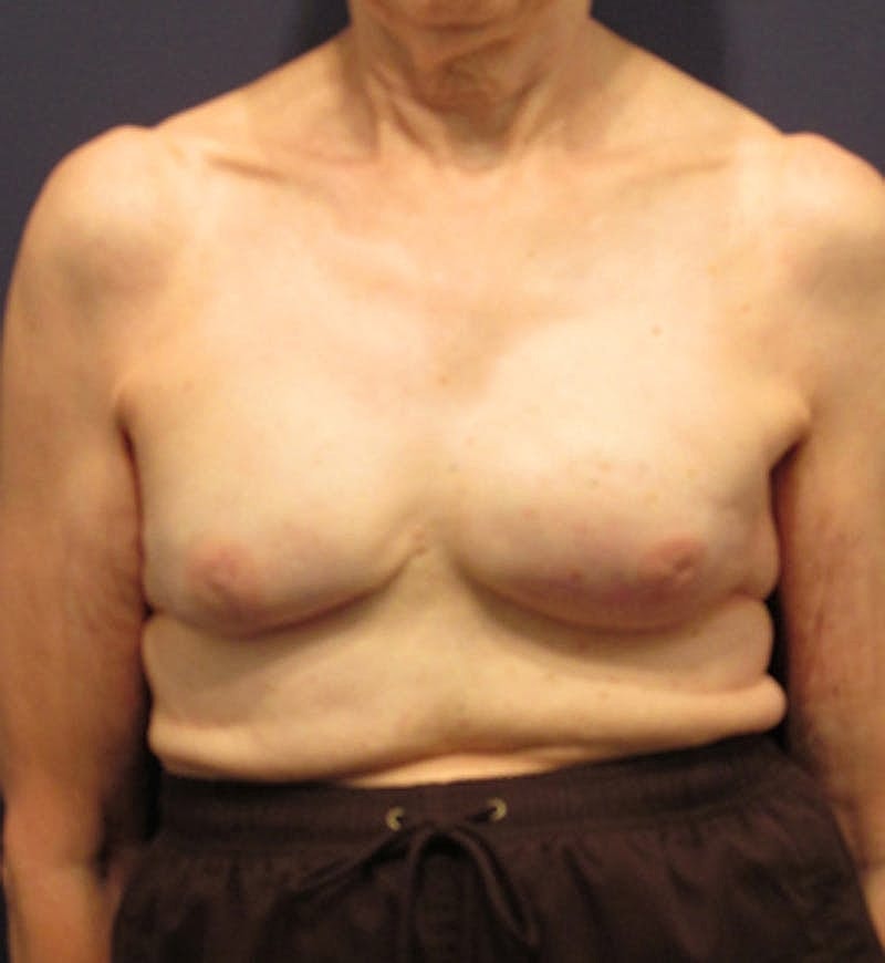 Breast Reconstruction Before & After