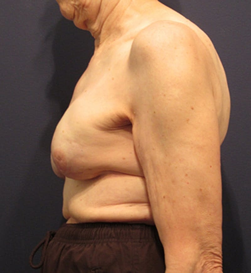 Breast Reconstruction Before & After