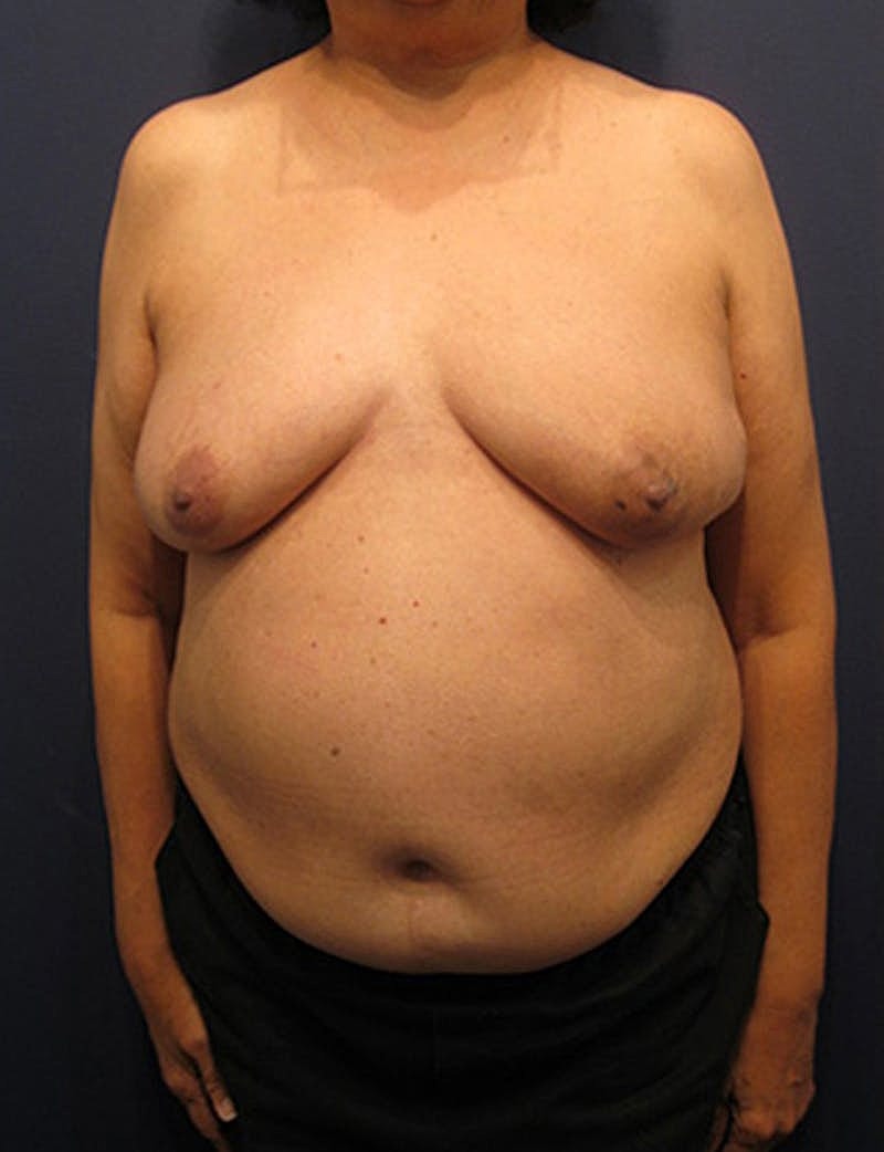 Breast Reconstruction Before & After