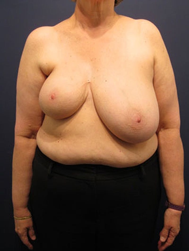 Breast Reconstruction Before & After