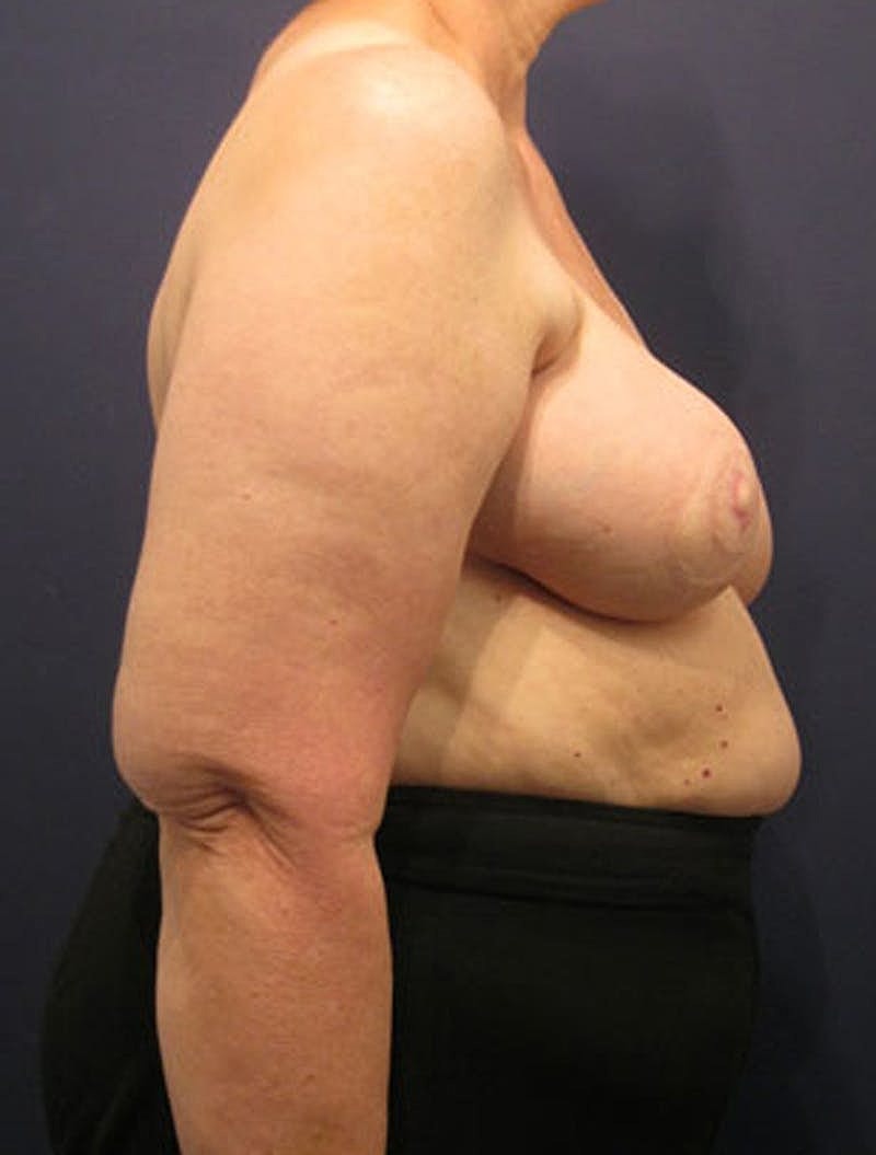 Breast Reconstruction Before & After