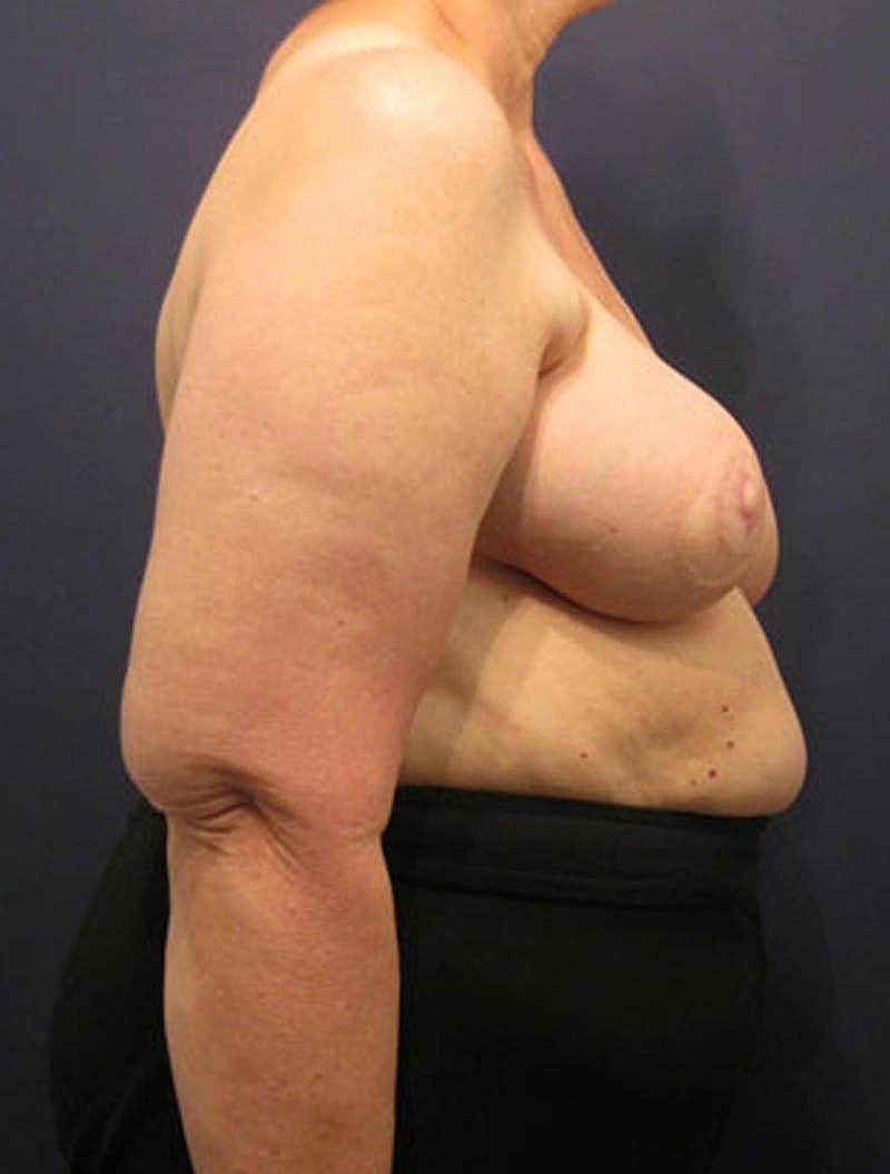 Breast Reconstruction Before & After