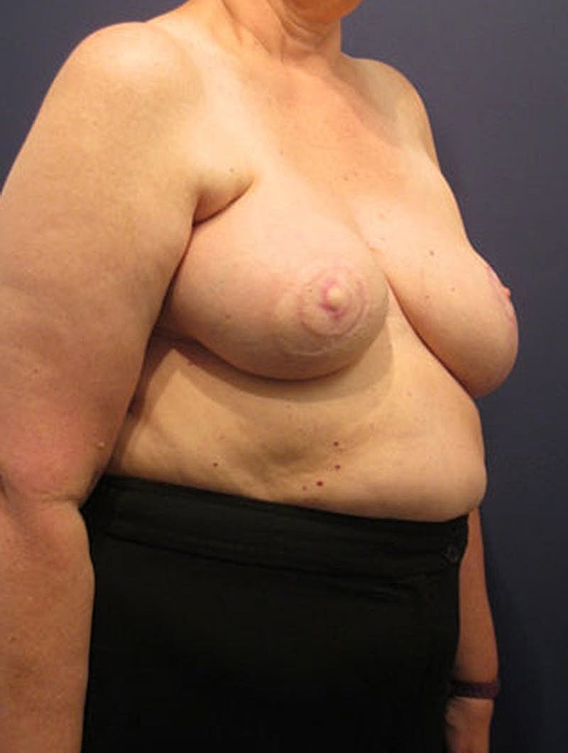 Breast Reconstruction Before & After