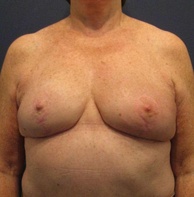 Breast Reconstruction Before & After
