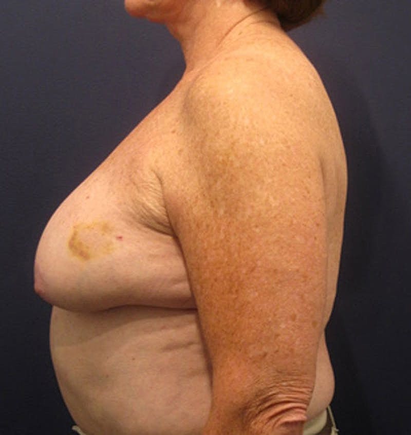 Breast Reconstruction Before & After