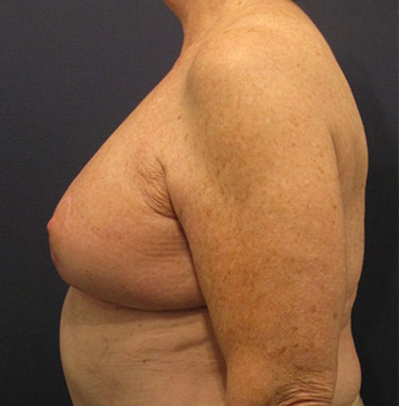 Breast Reconstruction Before & After
