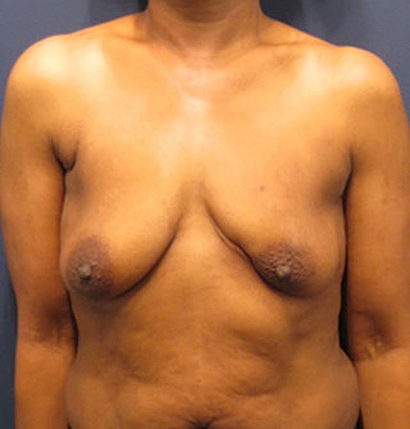 Breast Reconstruction Before & After