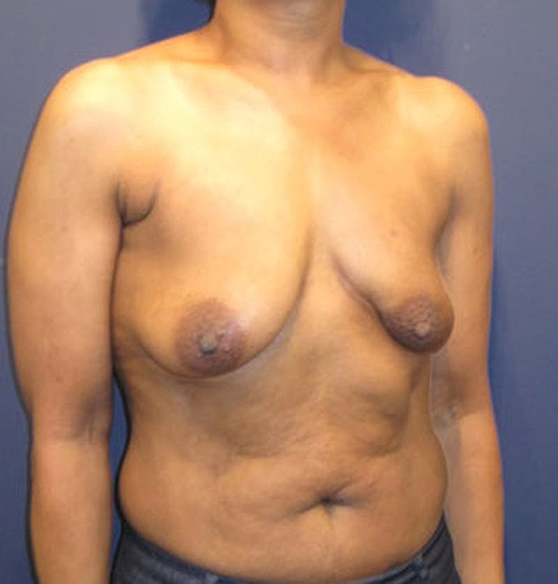 Breast Reconstruction Before & After