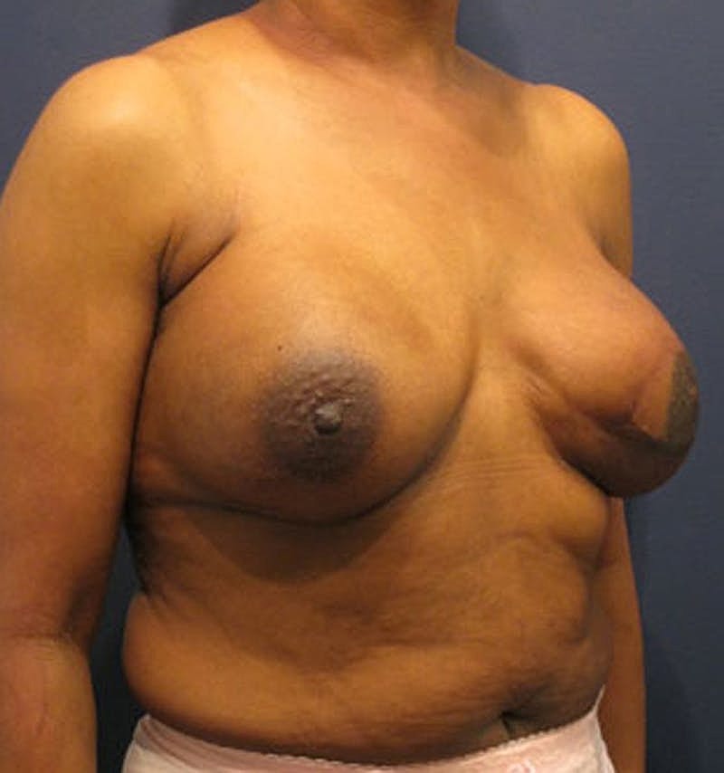 Breast Reconstruction Before & After