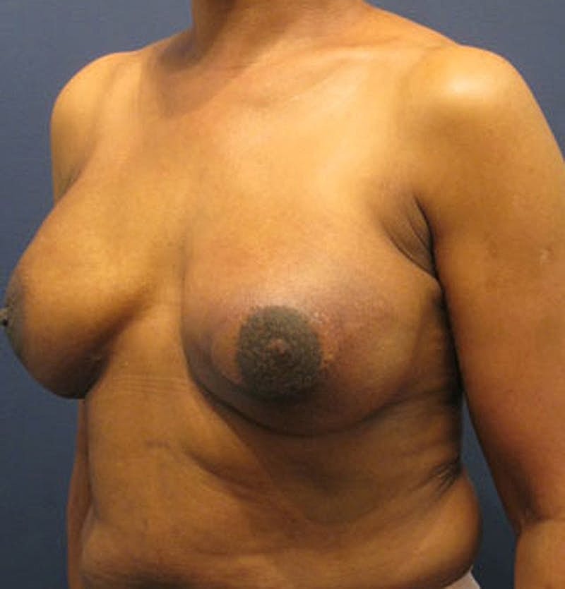 Breast Reconstruction Before & After