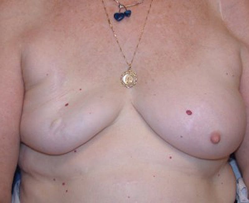 Breast Reconstruction Before & After