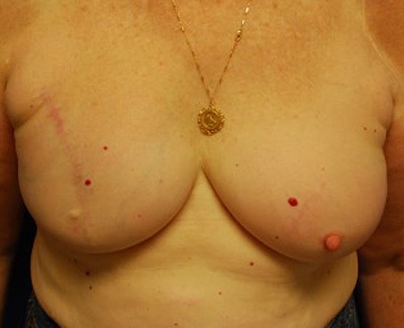 Breast Reconstruction Before & After