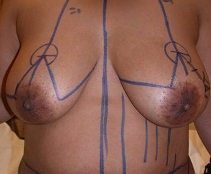 Breast Reconstruction Before & After