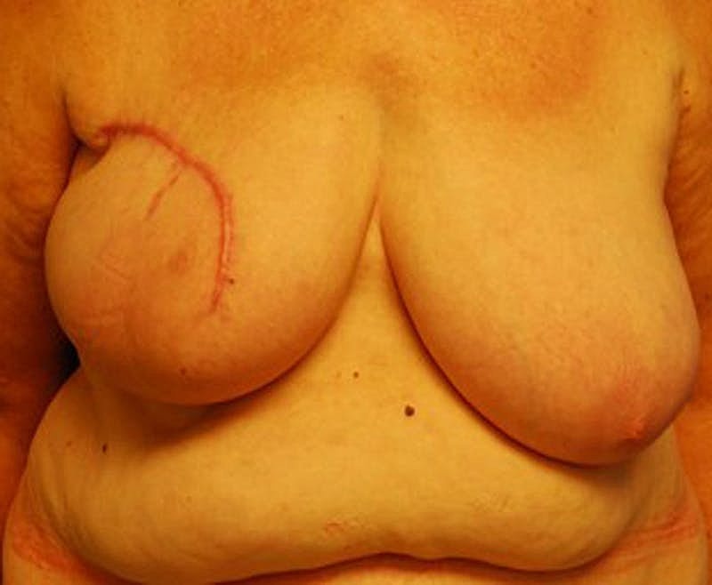 Breast Reconstruction Before & After