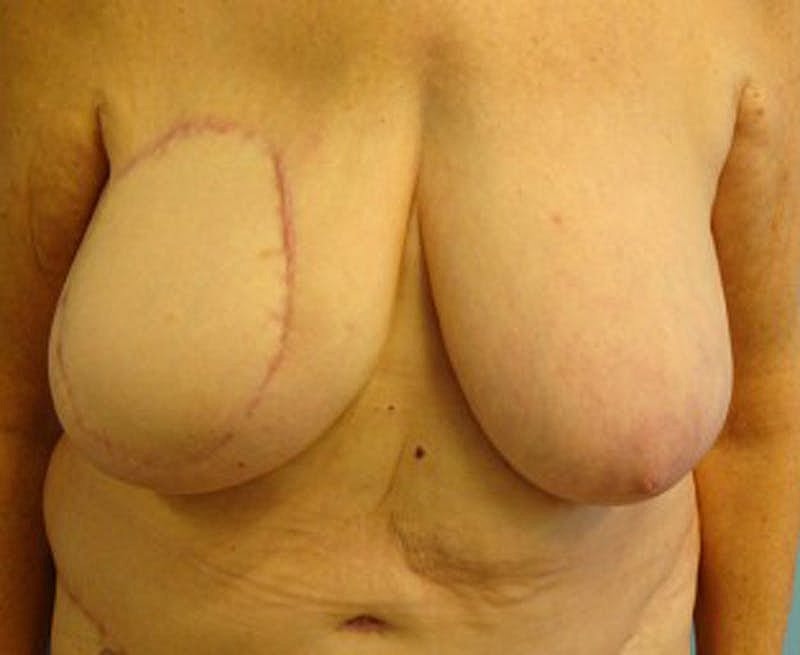 Breast Reconstruction Before & After