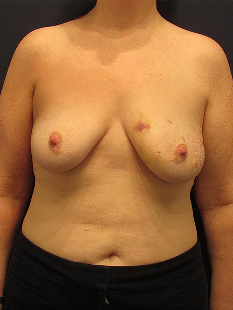 Breast Reconstruction Before & After
