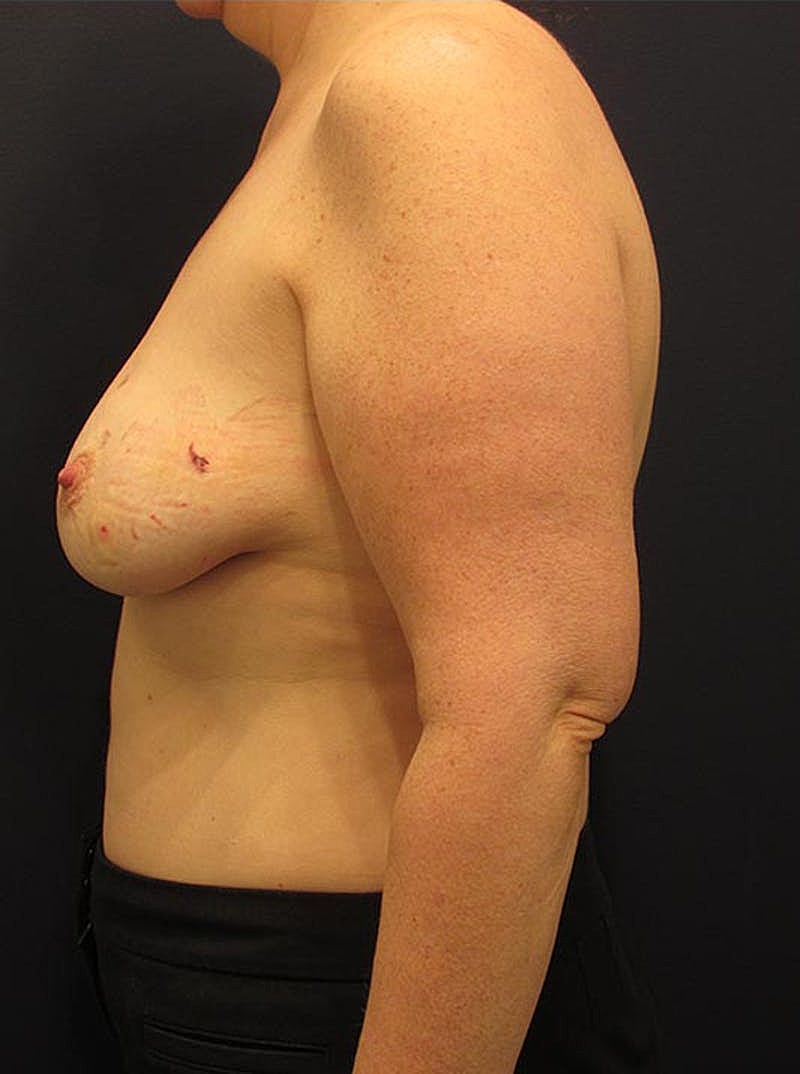 Breast Reconstruction Before & After