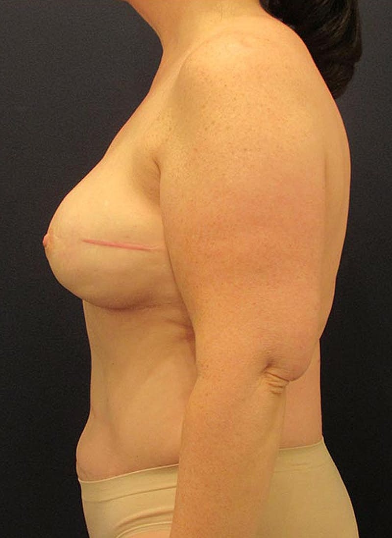 Breast Reconstruction Before & After