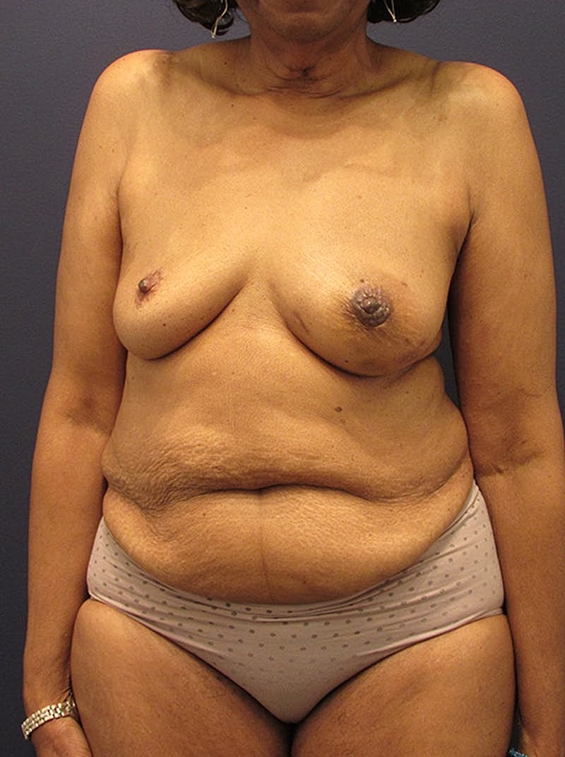 Breast Reconstruction Before & After