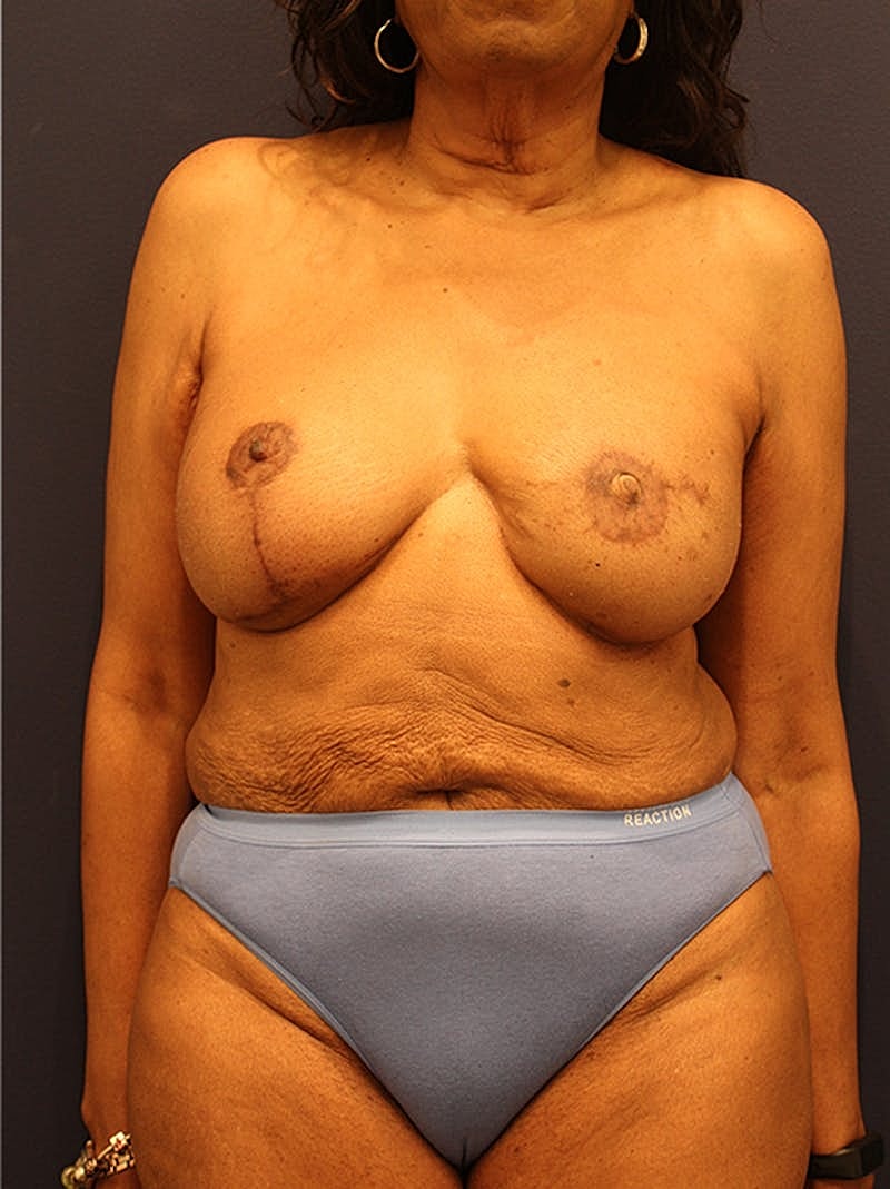 Breast Reconstruction Before & After