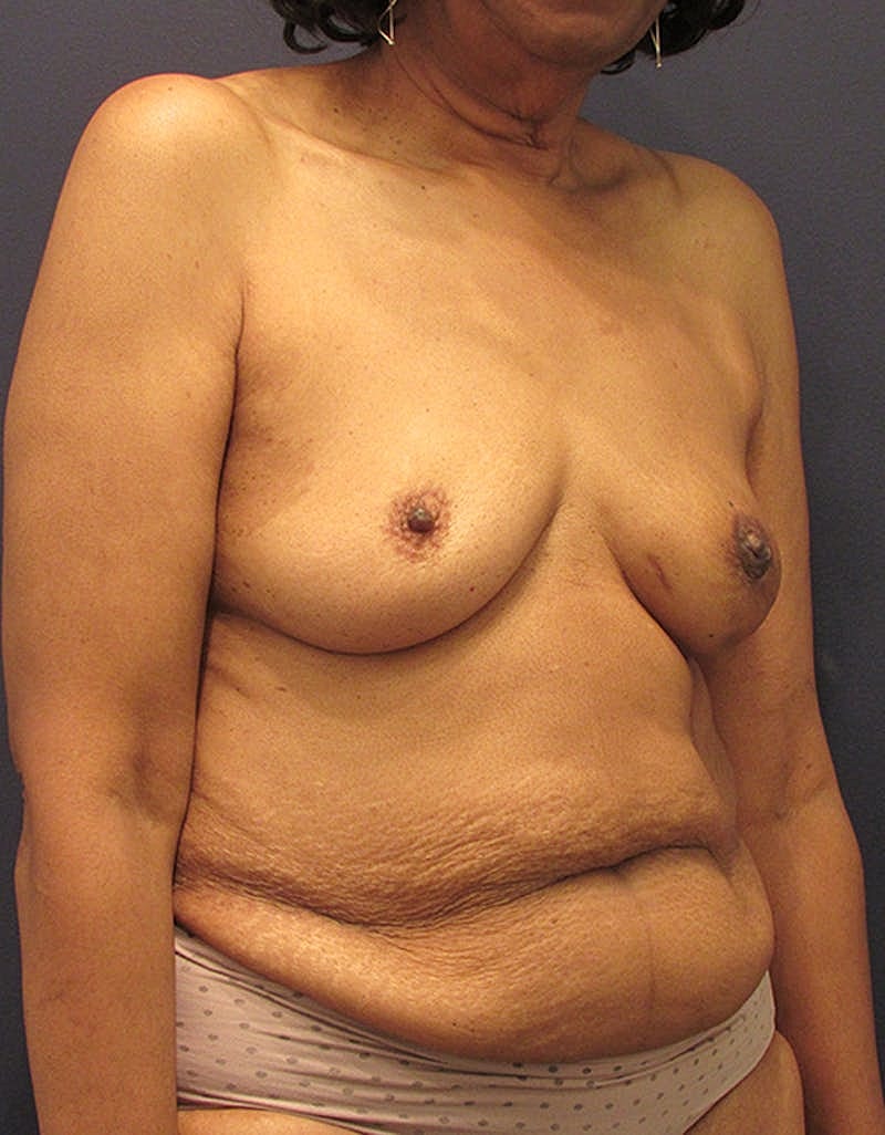 Breast Reconstruction Before & After
