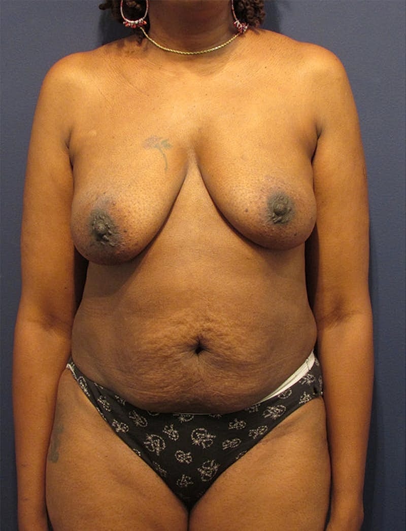 Breast Reconstruction Before & After