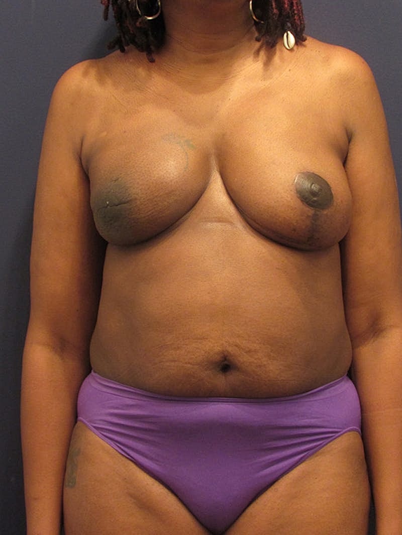 Breast Reconstruction Before & After