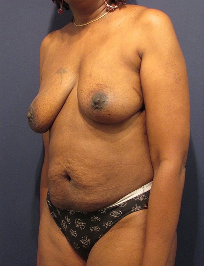 Breast Reconstruction Before & After