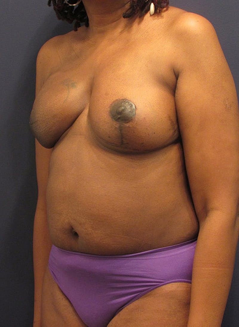 Breast Reconstruction Before & After