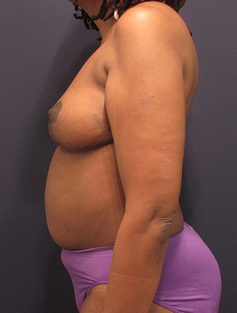 Breast Reconstruction Before & After