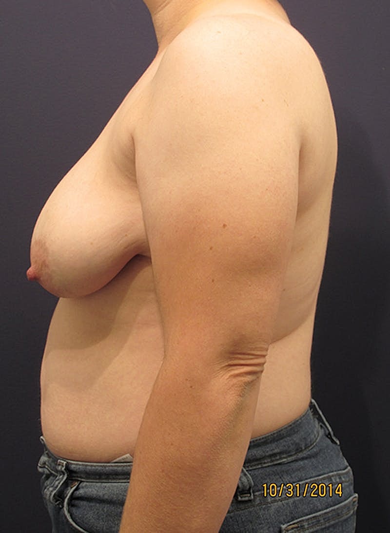 Breast Reconstruction Before & After
