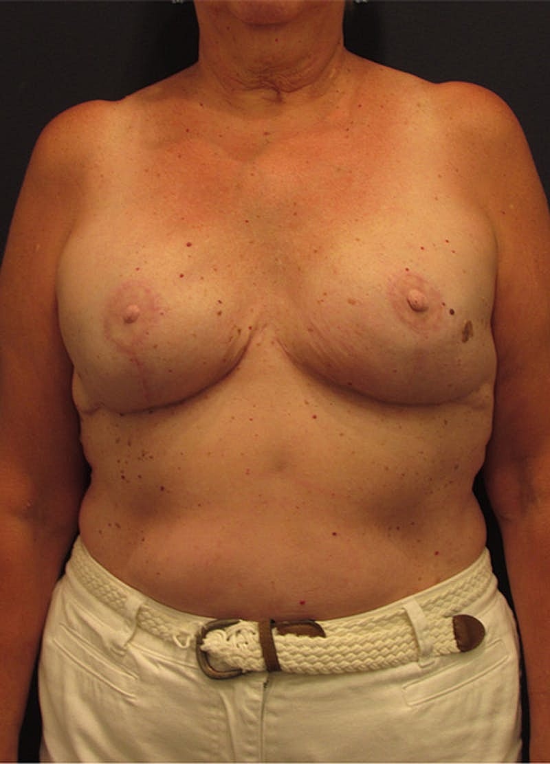 Breast Reconstruction Before & After