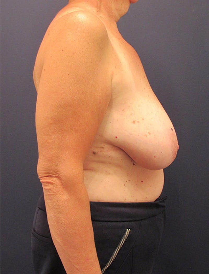 Breast Reconstruction Before & After