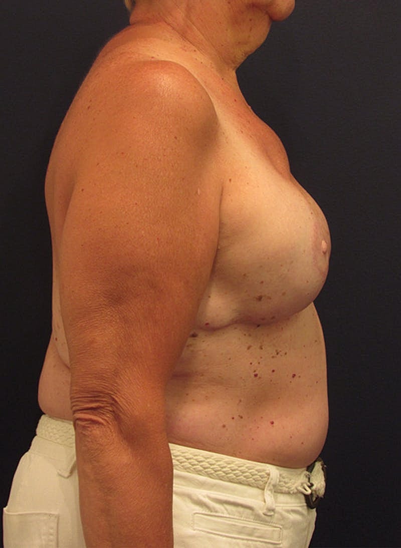 Breast Reconstruction Before & After