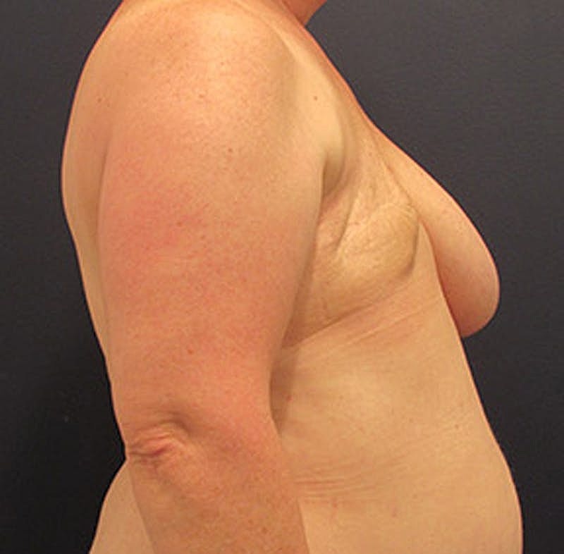 Breast Reconstruction Before & After