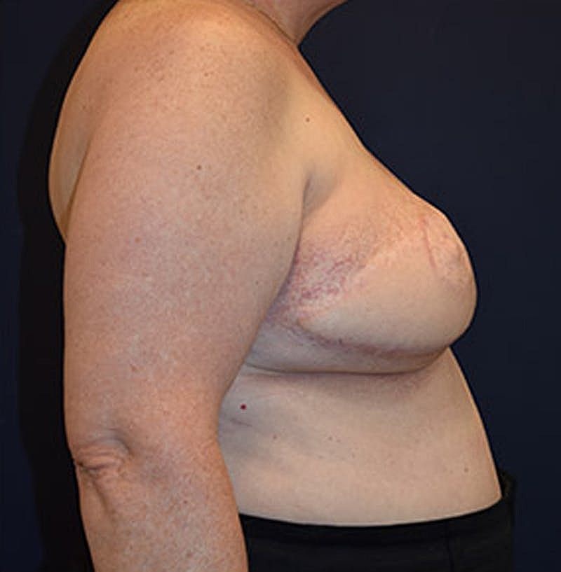 Breast Reconstruction Before & After