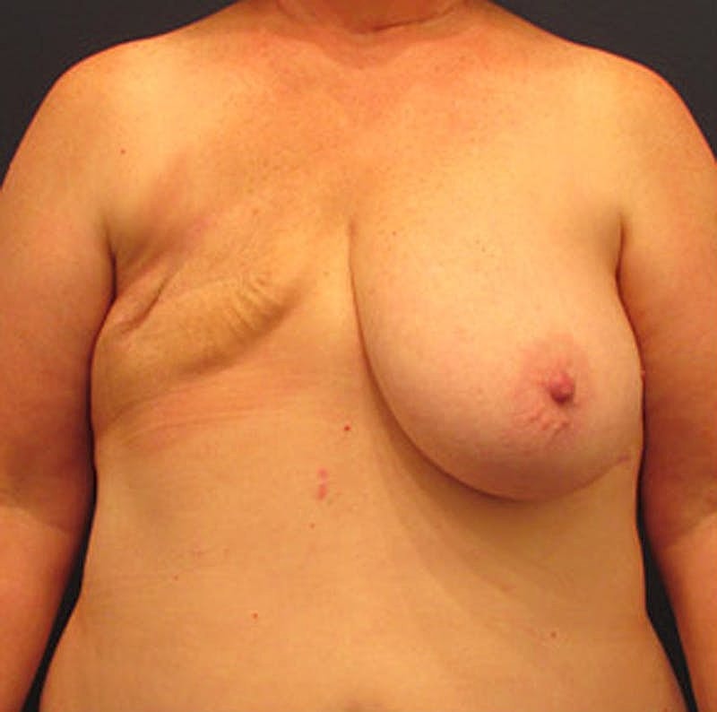 Breast Reconstruction Before & After