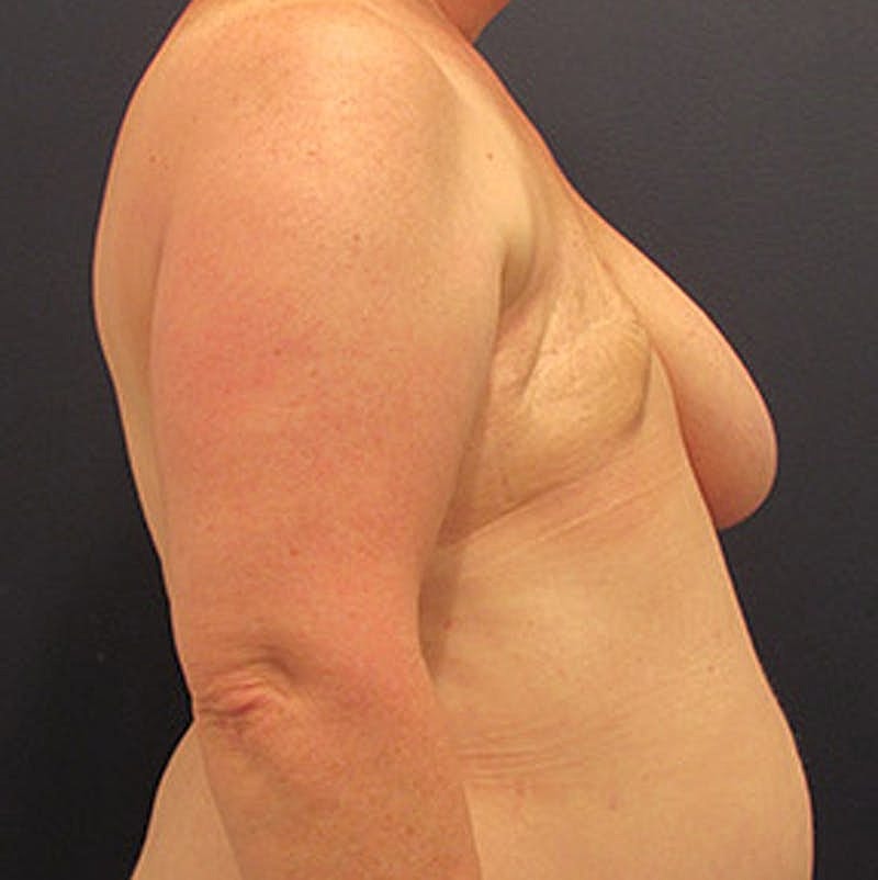 Breast Reconstruction Before & After
