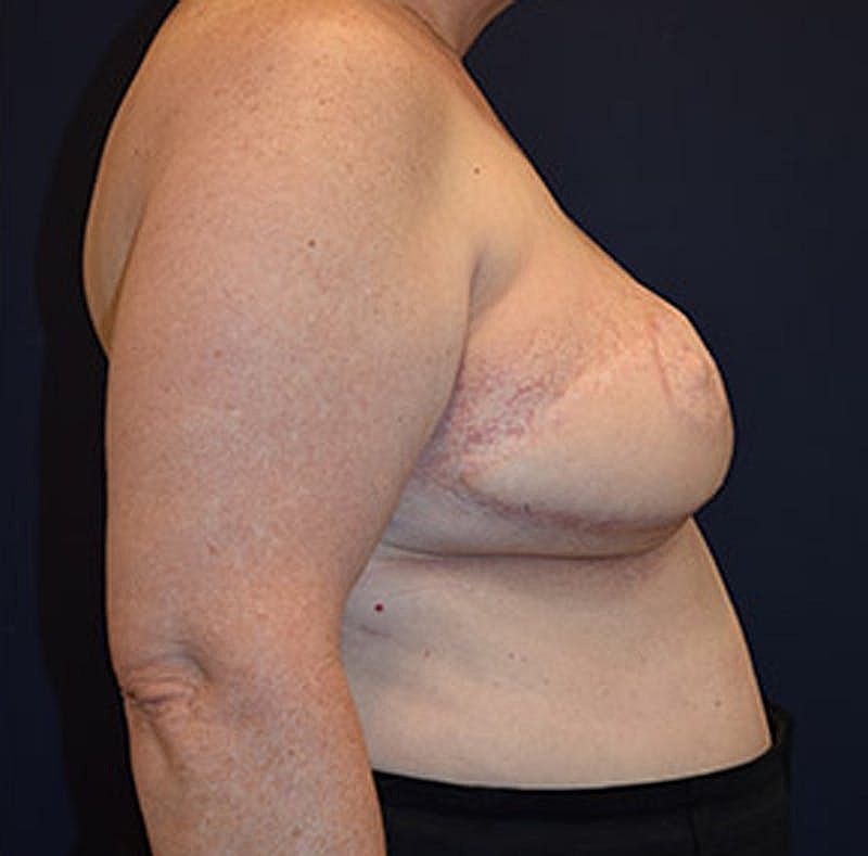Breast Reconstruction Before & After