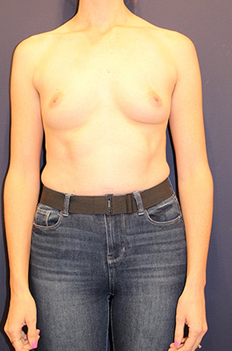 Breast Reconstruction Before & After