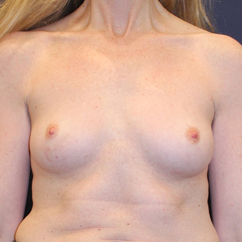 Breast Reconstruction Before & After