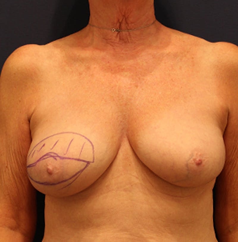 Breast Reconstruction Before & After