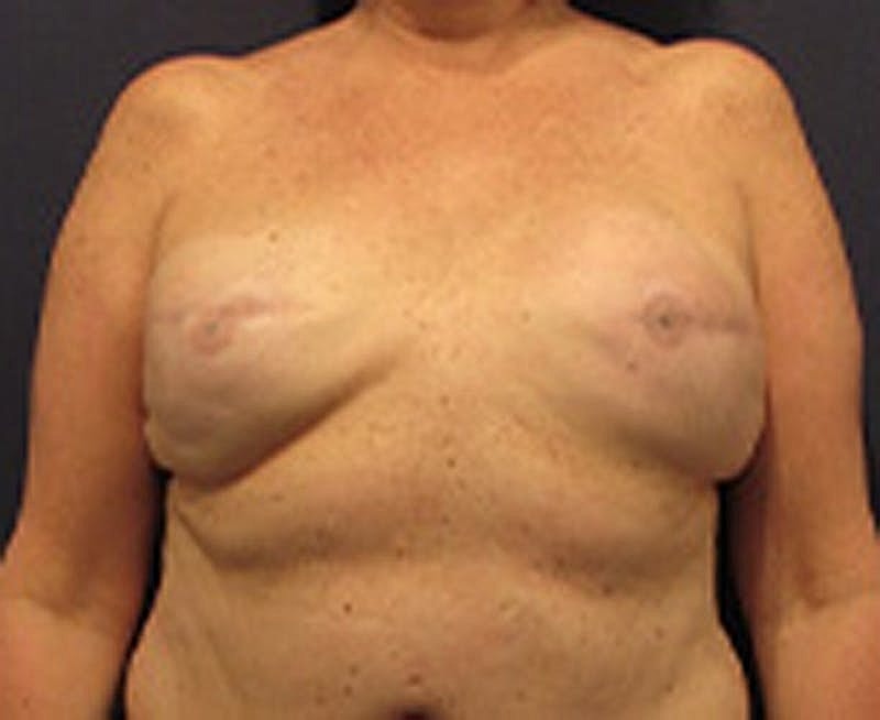 Breast Reconstruction Before & After