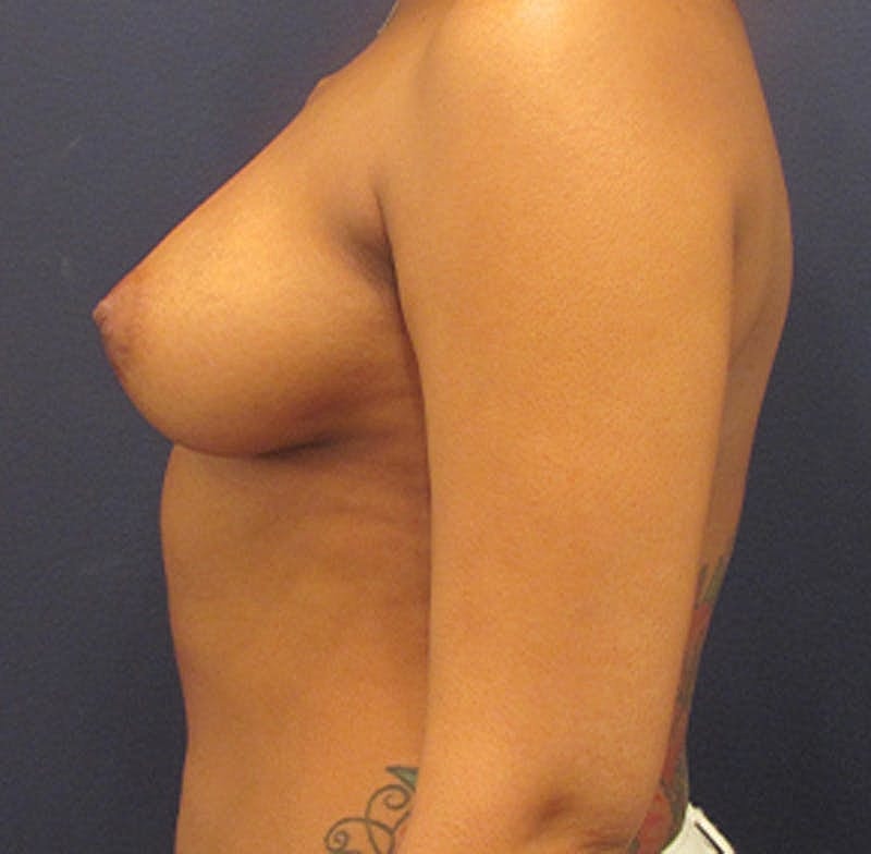 Breast Reconstruction Before & After