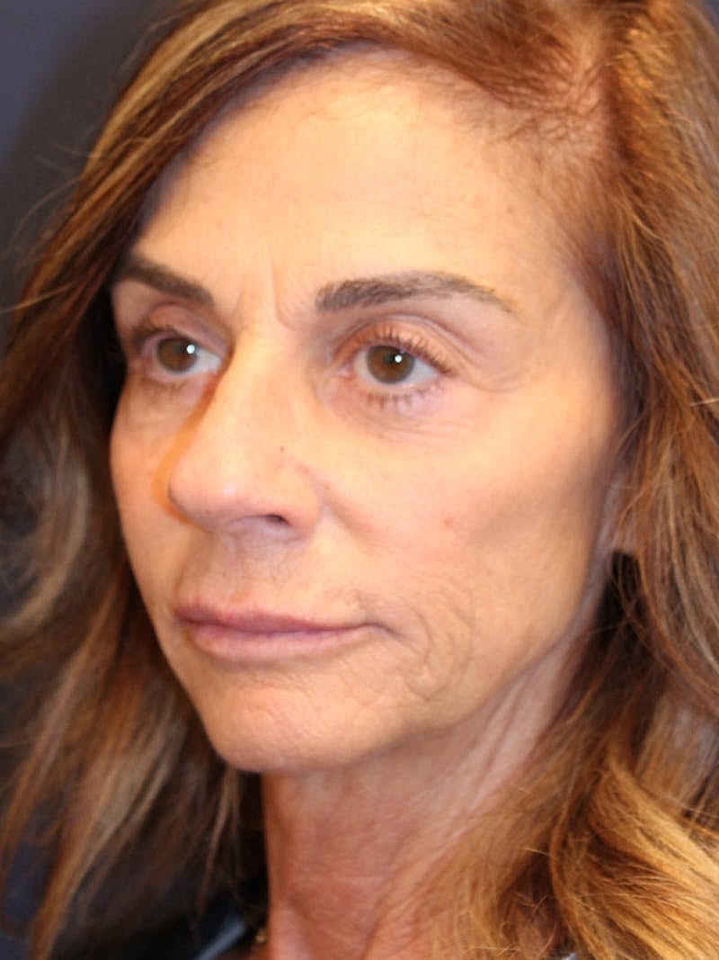 Dermal Fillers Before & After