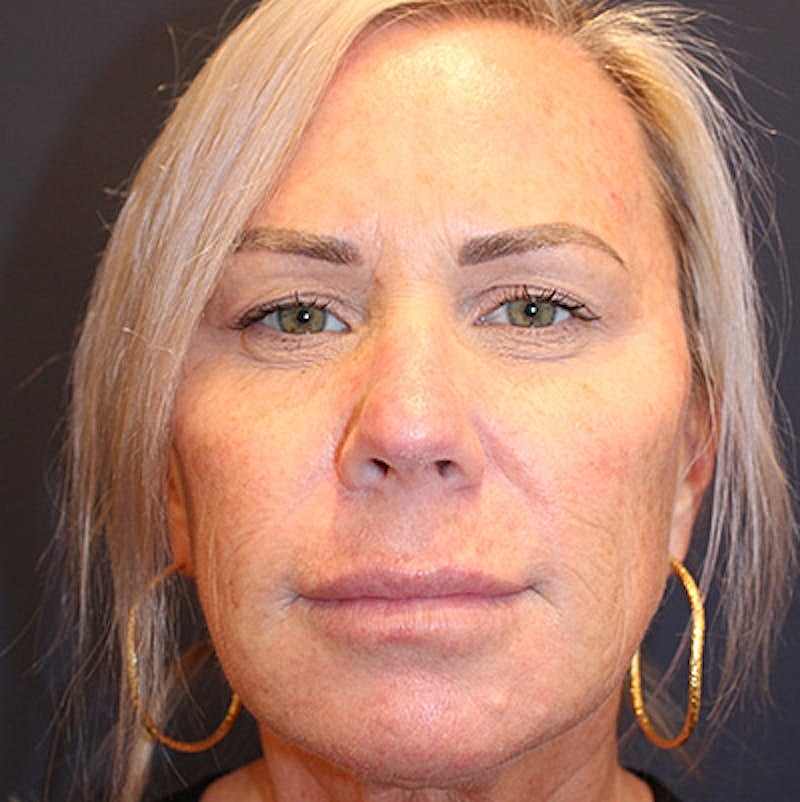 Dermal Fillers Before & After