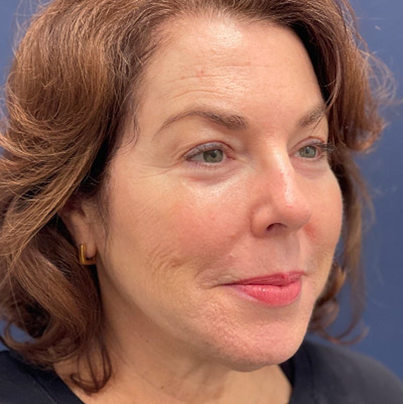 Dermal Fillers Before & After