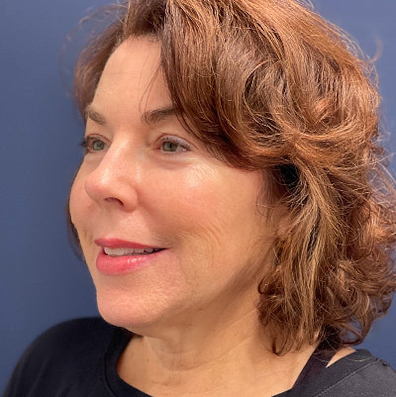 Dermal Fillers Before & After