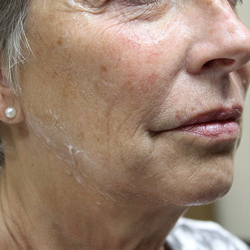 Dermal Fillers Before & After